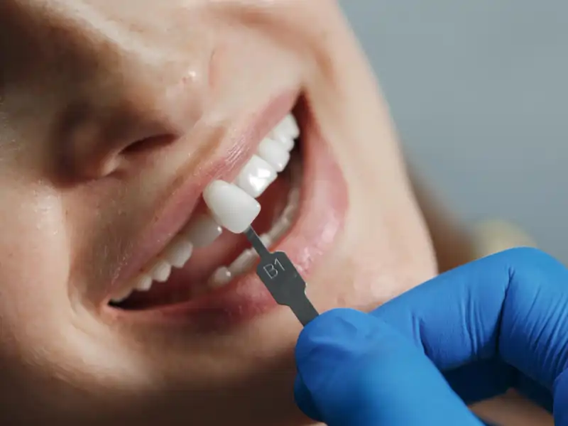 Dental implant lagos