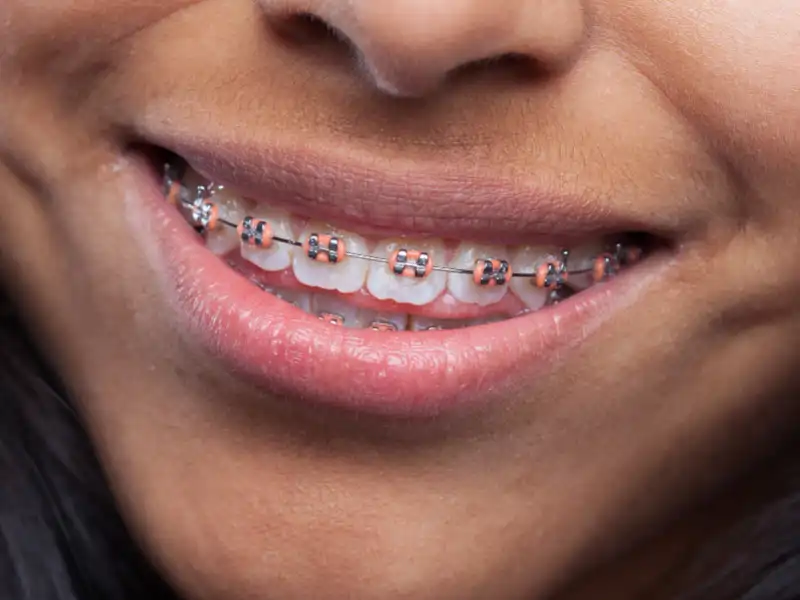 Orthodontic treatment Victoria Islands Lagos