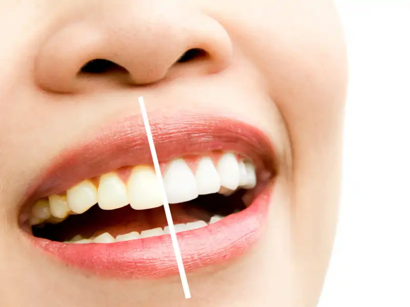 Teeth Whitening lagos